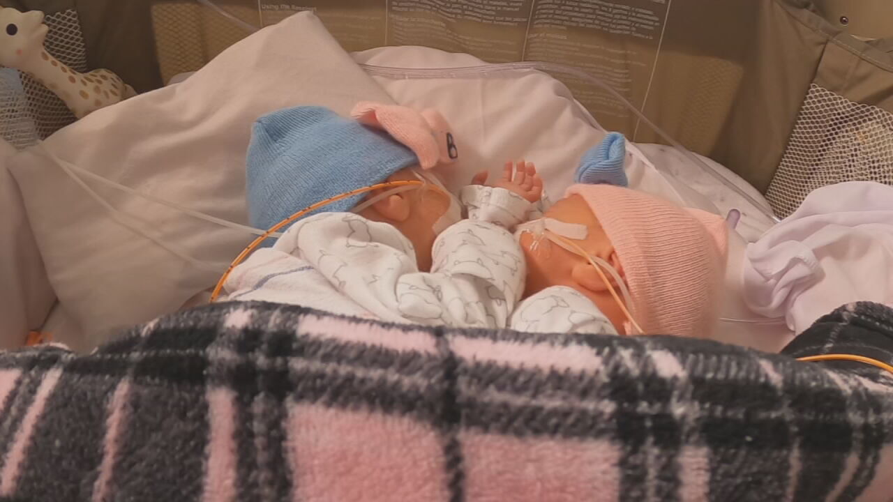 CONJOINED TWINS BORN IN LOUISVILLE